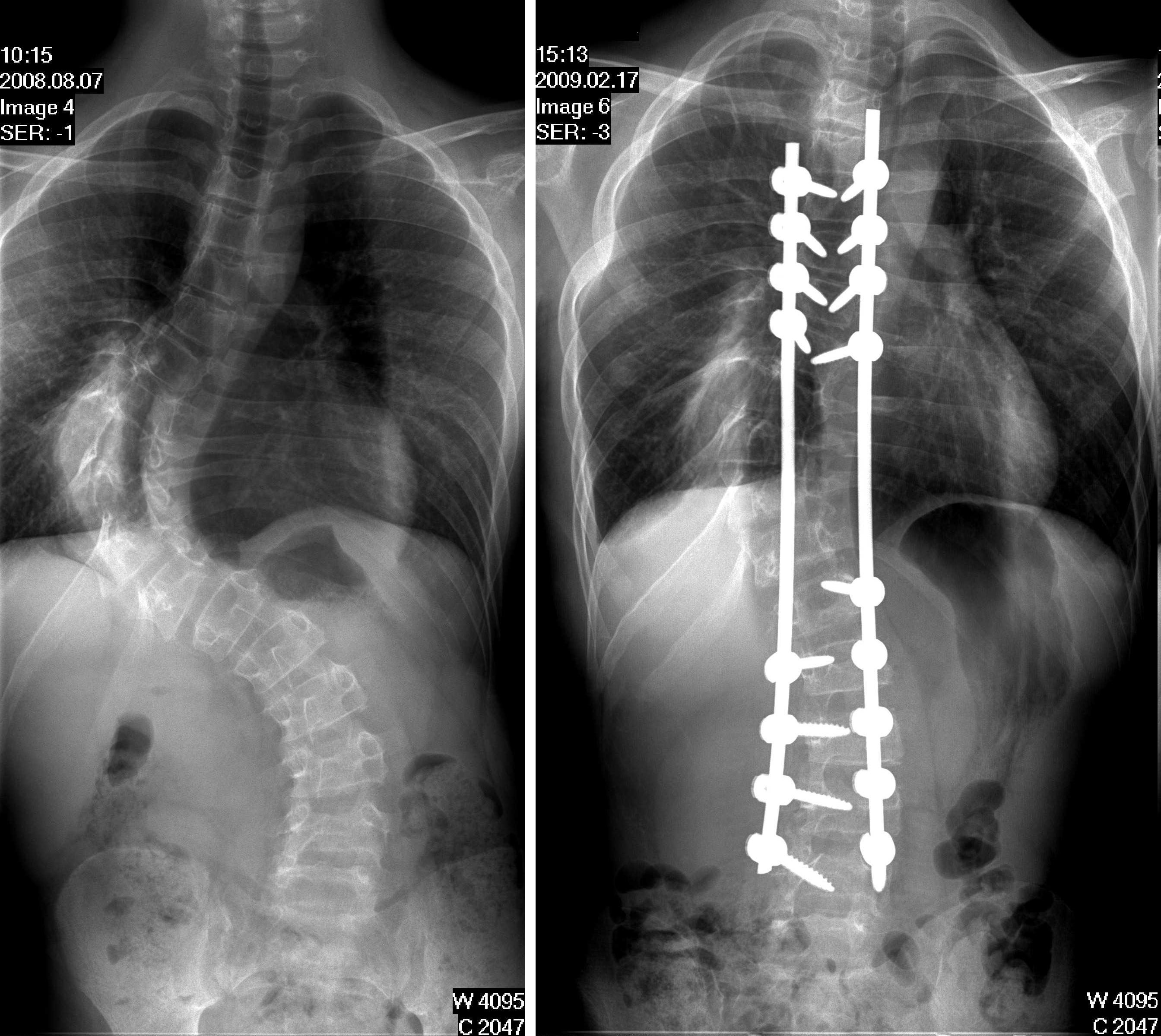 Röntgenfelvétel a gerincoszlopról a műtétet megelőzően és követően. 